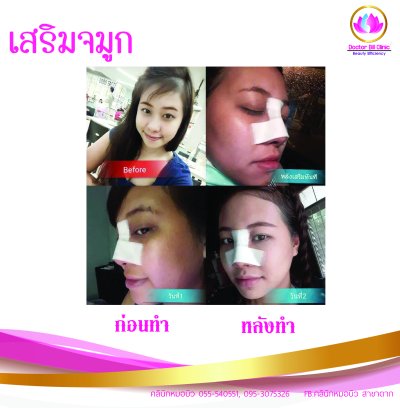 รูปผลการทำศัลยกรรมจมูก